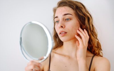 5 Pflegetipps bei Akne und unreiner Haut