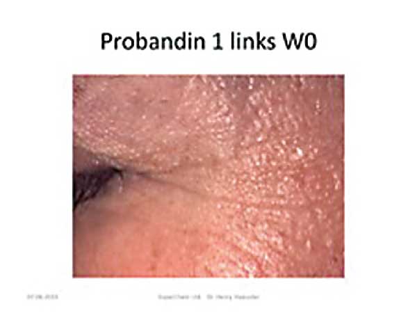 Die Haut neben dem linken Auge einer Probandin vor der Behandlung