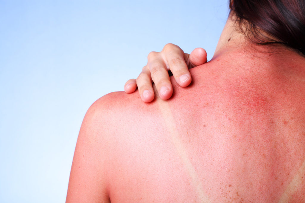 Sonnenbrand Rücken